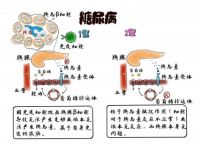 为什么糖尿病患者常伴有TG升高的简单介绍